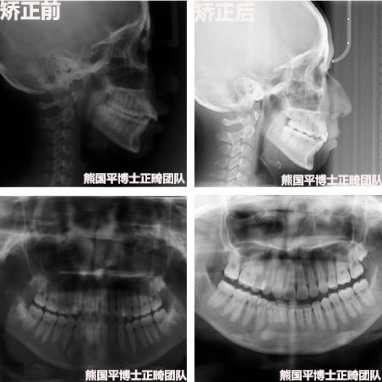 23 岁女子因牙齿问题开启牙套之旅，深覆盖矫正方法及效果解析