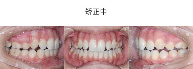 23 岁女子因牙齿问题开启牙套之旅，深覆盖矫正方法及效果解析