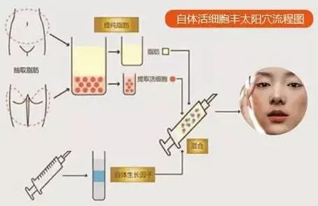 丰太阳穴：改善面相，提升颜值的秘诀